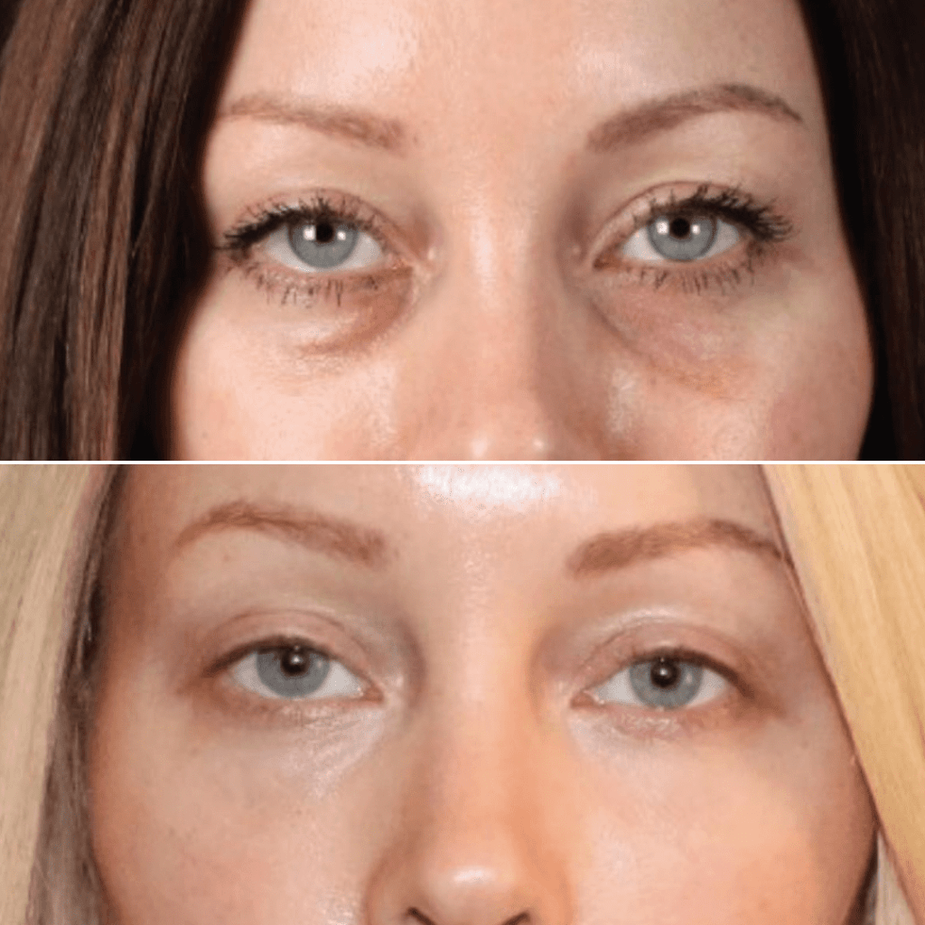 PRF Treatments Before And After Photos MD Esthetics